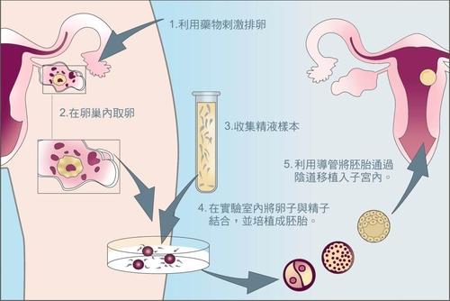 宜昌合法试管婴儿机构:卵巢囊肿的最佳药物是什么，如何治疗卵巢囊肿的研究。