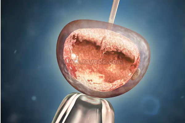 大连借卵试管助孕流程：如何提高多囊卵巢的试管婴儿的成功率？